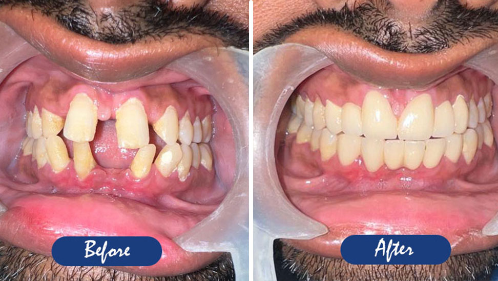 before and after image of cosmetic dentistry in kolkata