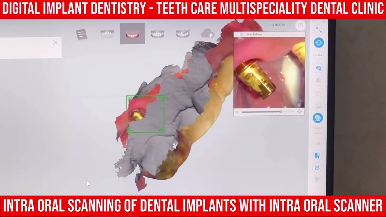 Digital intraoral scanning for dental implants at Teeth Care Multispeciality Dental Clinic in Kolkata