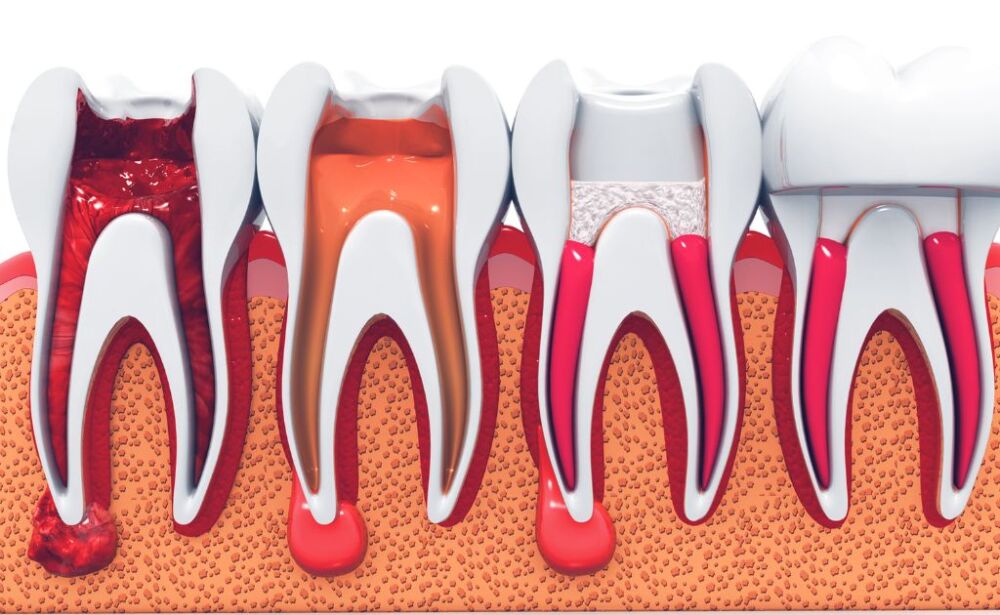 Expert Endodontic Treatment in Kolkata