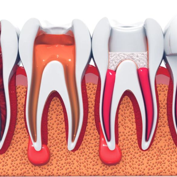 Expert Endodontic Treatment in Kolkata