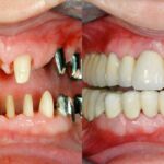 Restore Your Smile with Expert Implantology in Kolkata