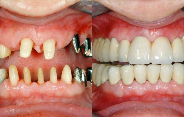 How Long Is the Recovery Time for Dental Implants? 11 Restore Your Smile with Expert Implantology in Kolkata