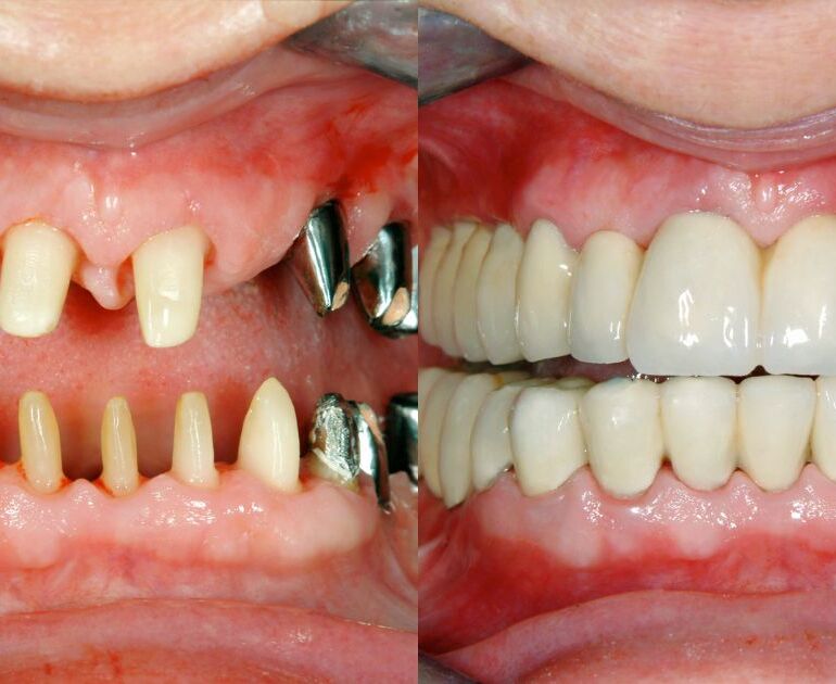 Restore Your Smile with Expert Implantology in Kolkata
