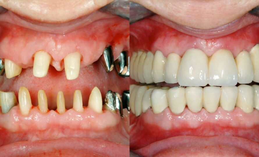 Restore Your Smile with Expert Implantology in Kolkata