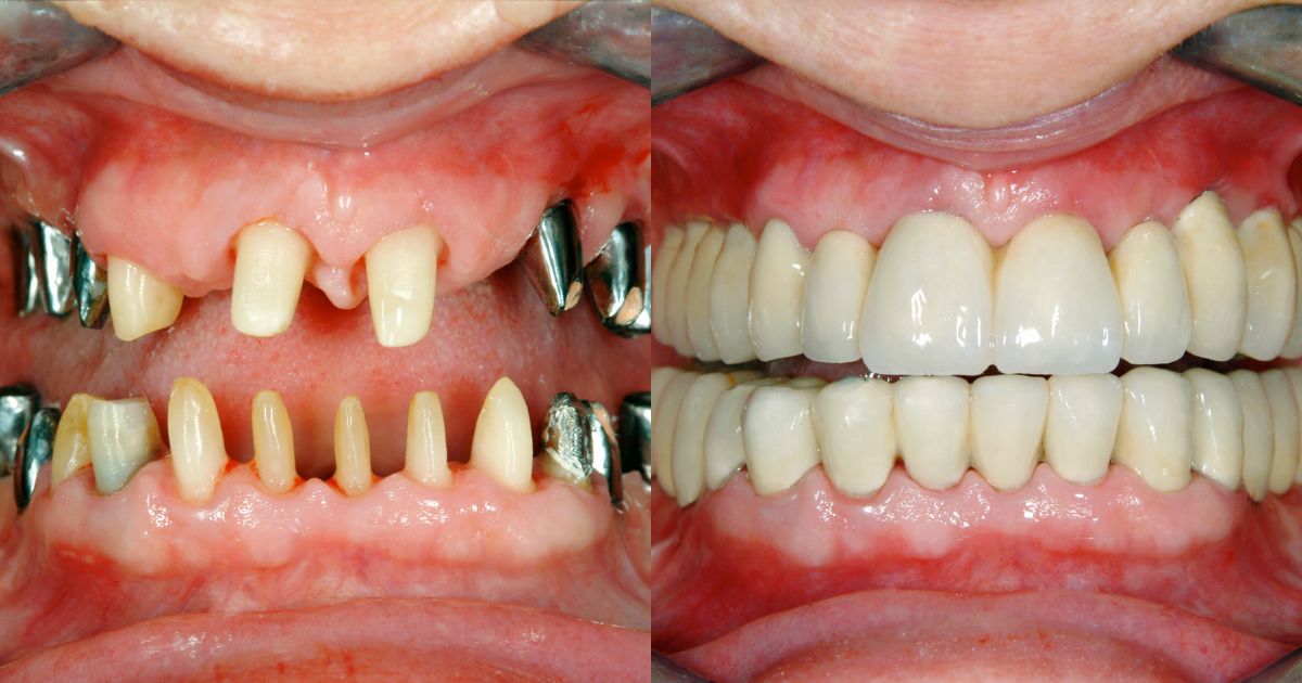 Restore Your Smile with Expert Implantology in Kolkata