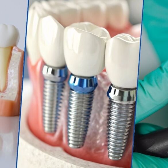 Restore Your Smile with Expert Implantology in Kolkata