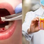 Tooth Extraction or RCT: Which Treatment Is Right for You?