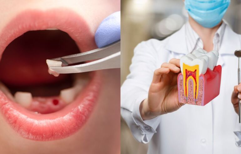 Tooth Extraction or RCT: Which Treatment Is Right for You?
