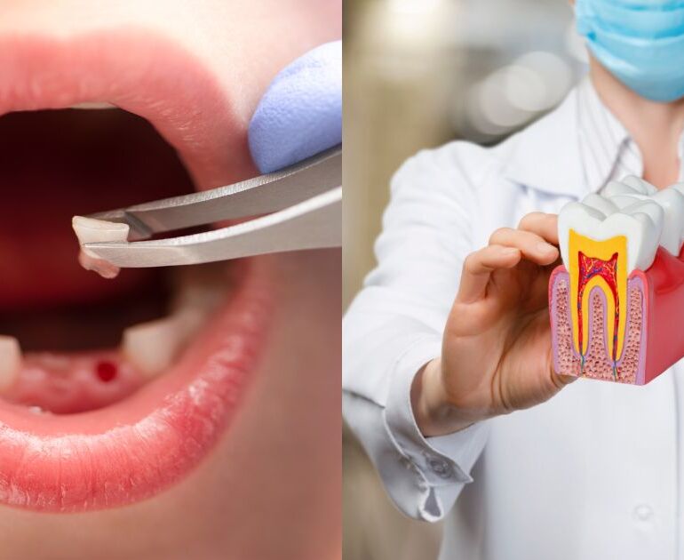 Tooth Extraction or RCT: Which Treatment Is Right for You? 10 Tooth Extraction or RCT: Which Treatment Is Right for You?