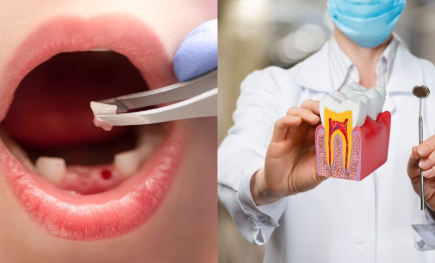 Tooth Extraction or RCT: Which Treatment Is Right for You?