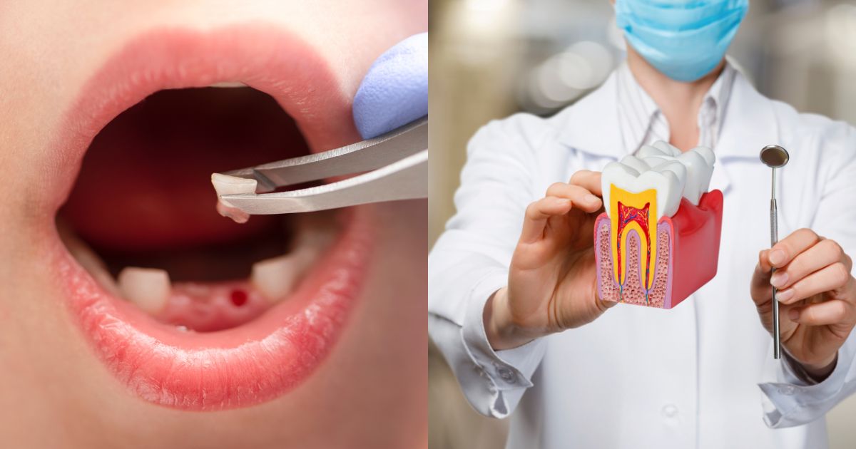 Tooth Extraction or RCT: Which Treatment Is Right for You?