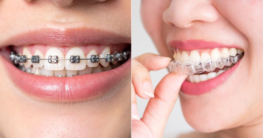 Side-by-side image showing traditional metal braces on one set of teeth and clear aligners on another, highlighting orthodontic treatment differences.
