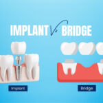 Single Tooth Implant vs Bridge in Kolkata