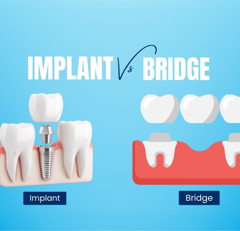 Single Tooth Implant vs Bridge in Kolkata 2 Single Tooth Implant vs Bridge in Kolkata