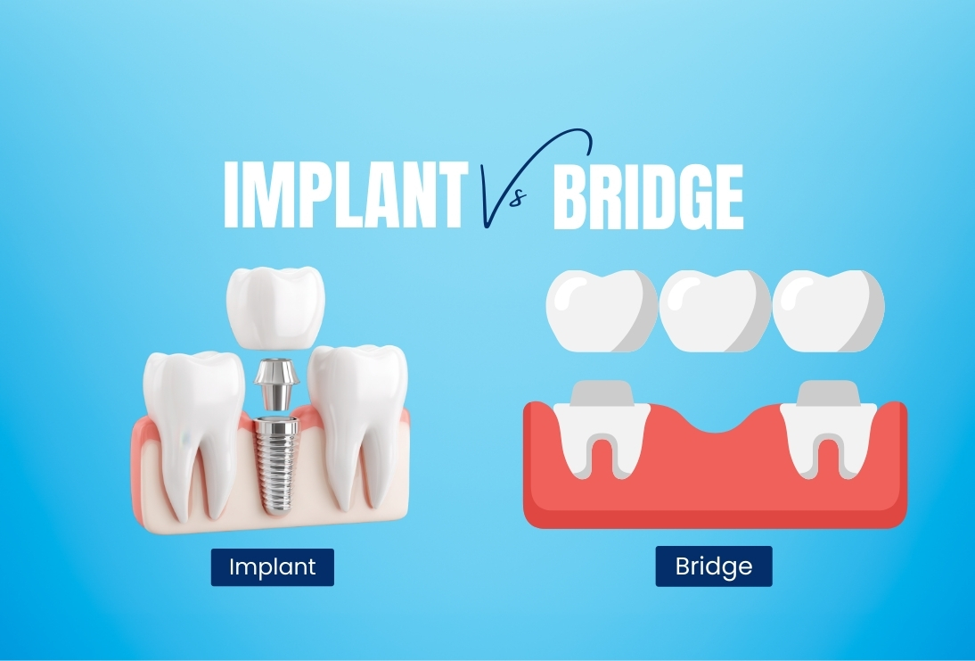Single Tooth Implant vs Bridge in Kolkata