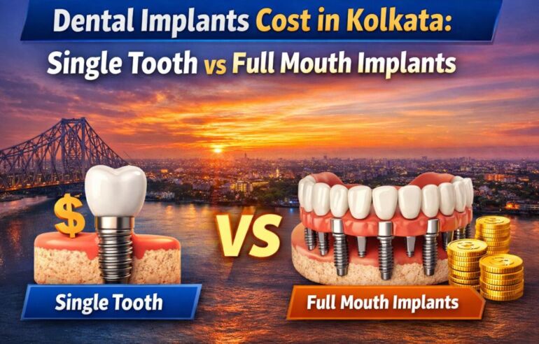 Dental Implants Cost in Kolkata: Single Tooth vs Full Mouth Implants 3 Dental Implants Cost in Kolkata | Single Tooth vs Full Mouth Implants