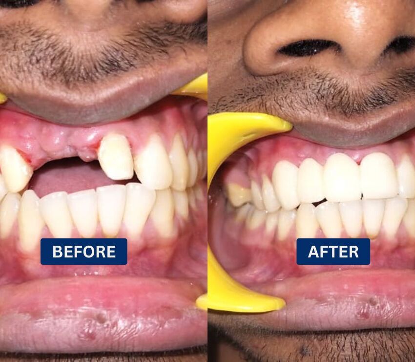 Dental Implants in Kolkata – Restoring a Confident Smile After Tooth Loss