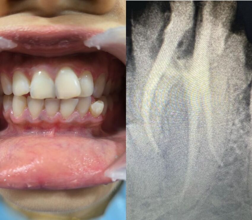 RCT in Kolkata – Saving a Damaged Tooth with Advanced Root Canal Treatment