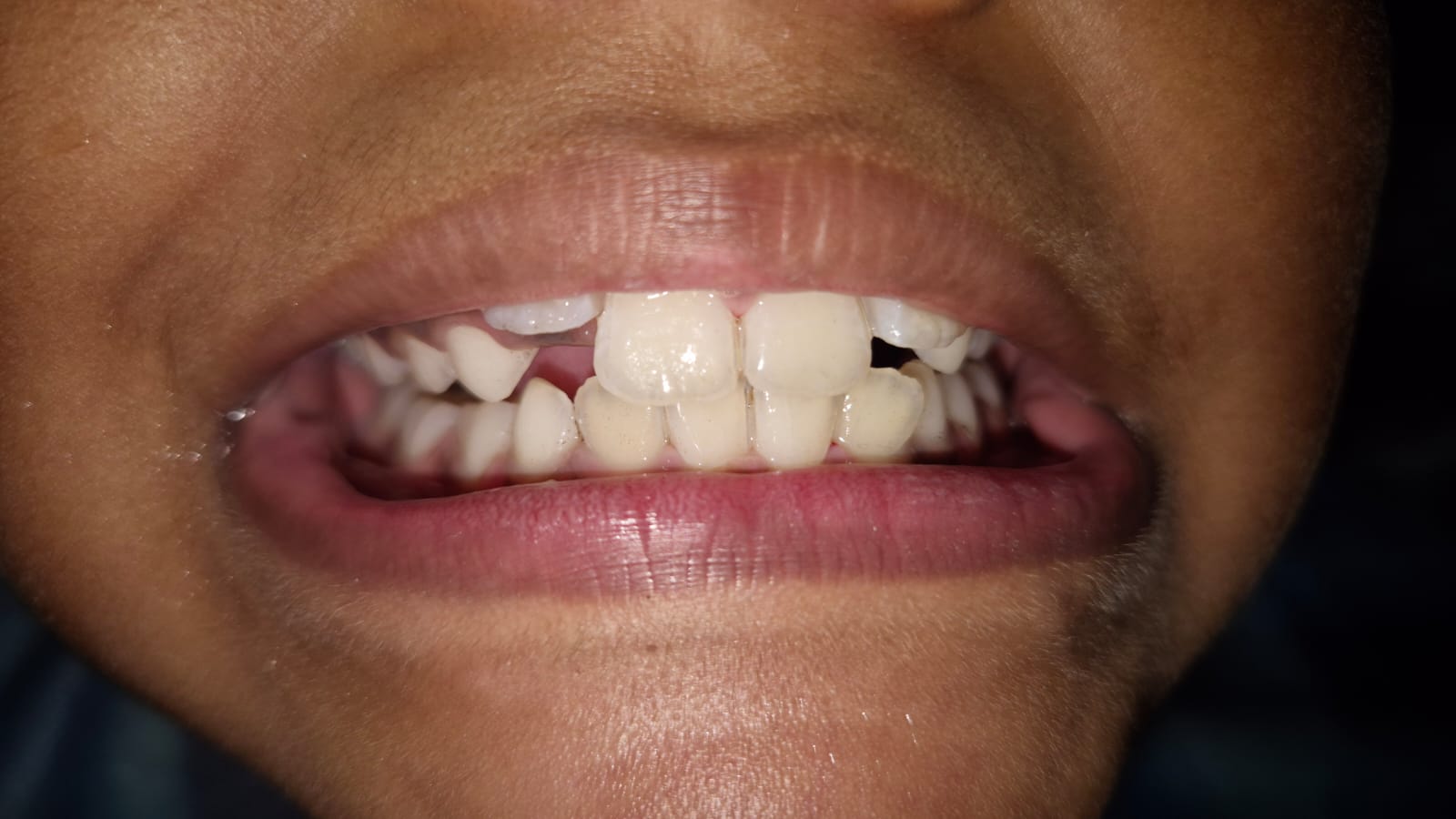 Teeth cleaning after image showing clean, stain-free teeth following professional dental scaling and polishing treatment.