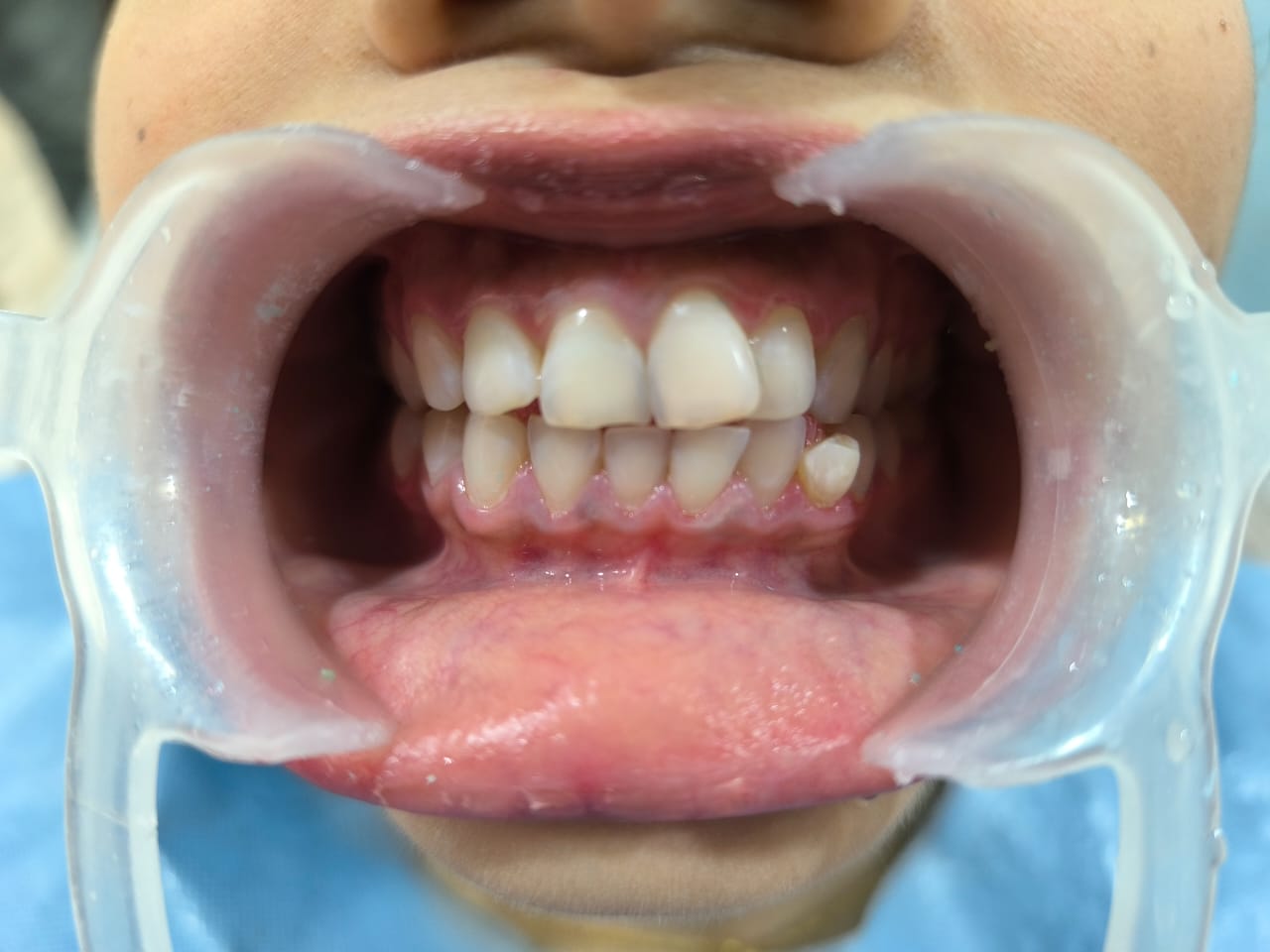 Teeth cleaning after image showing clean teeth, healthy gums, and improved oral hygiene following professional dental scaling and polishing.