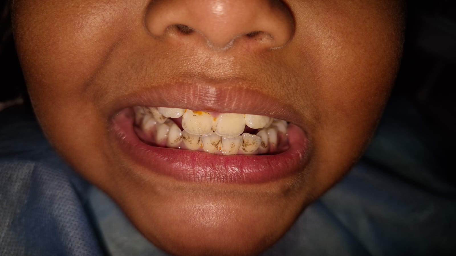 Teeth cleaning before image showing plaque, tartar buildup, and staining on teeth prior to professional dental cleaning.