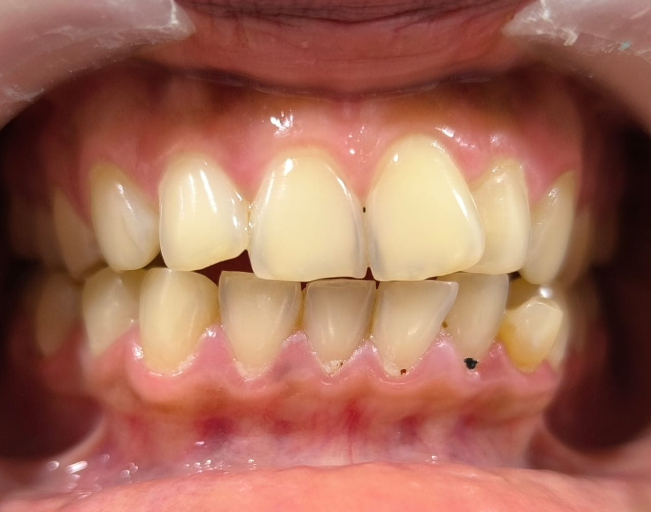 Teeth cleaning before image showing plaque and tartar buildup near the gums before professional dental cleaning treatment.