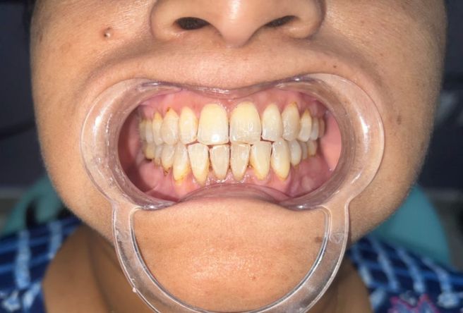 After teeth cleaning in Kolkata showing reduced plaque and improved gum health following professional dental scaling