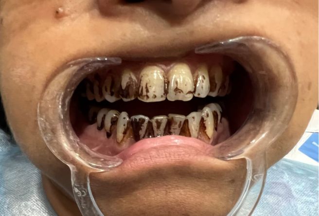 Teeth Cleaning in Kolkata – Before Dental Scaling Treatment Before teeth cleaning in Kolkata showing heavy tartar and plaque buildup on teeth requiring dental scaling