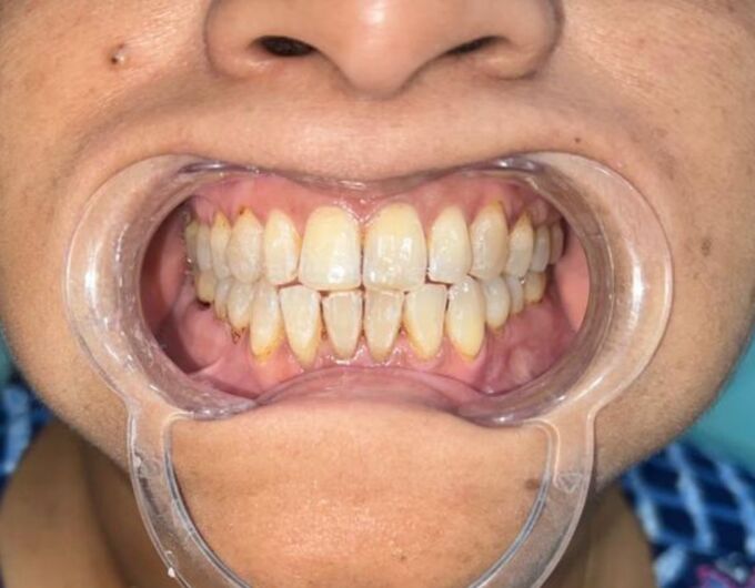 After Teeth Whitening in Kolkata showing pearl white smile achieved in three sessions at Teeth Care Multispeciality Dental Clinic