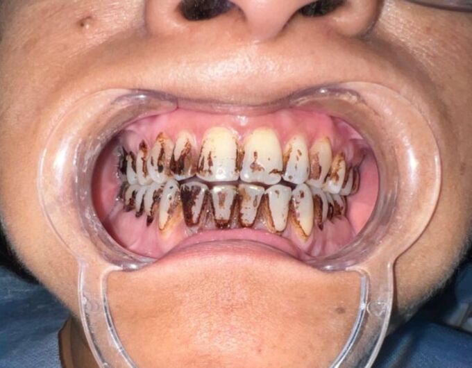 Before Teeth Whitening in Kolkata showing yellow and stained teeth of patient at Teeth Care Multispeciality Dental Clinic