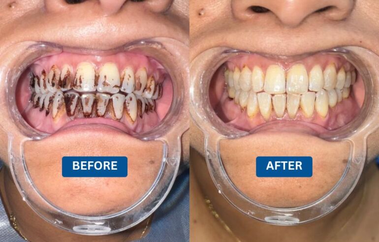 Case Study: Teeth Whitening in Kolkata – Restoring a Pearl White Smile at Teeth Care Multispeciality Dental Clinic