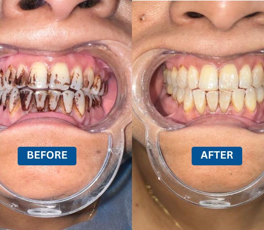 Case Study: Teeth Whitening in Kolkata – Restoring a Pearl White Smile at Teeth Care Multispeciality Dental Clinic