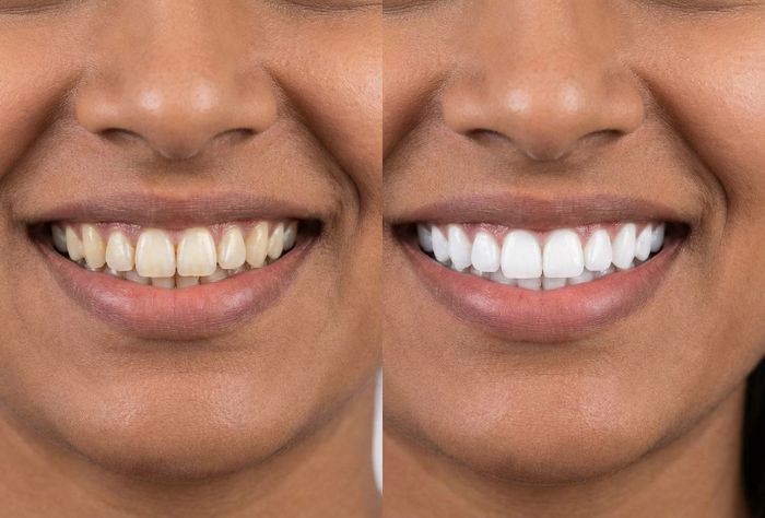 Close-up before and after image of teeh belaching in kolkata showing removal of yellow stains and improved tooth color.