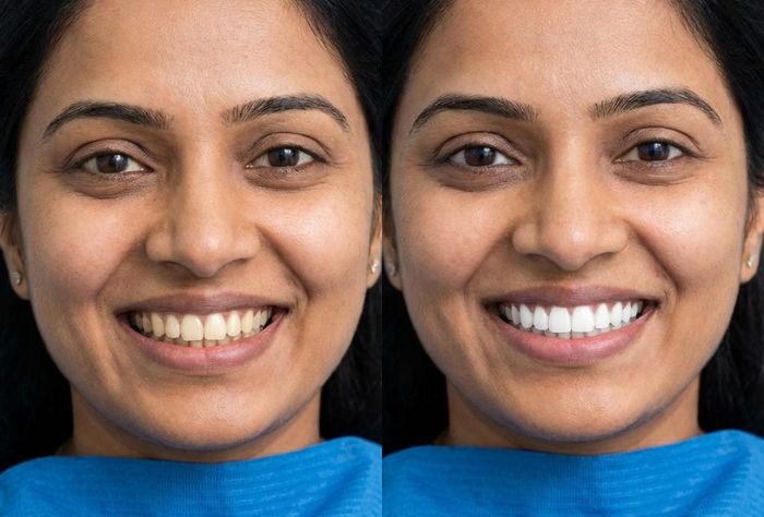 Patient smile before and after teeh belaching in kolkata showing enhanced tooth brightness and cosmetic dental improvement.