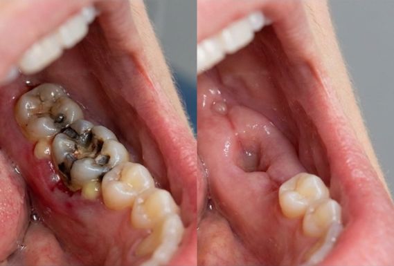 Dental tooth extraction before and after comparison showing infected molar removal and healing gums related to tooth extraction cost in Kolkata.