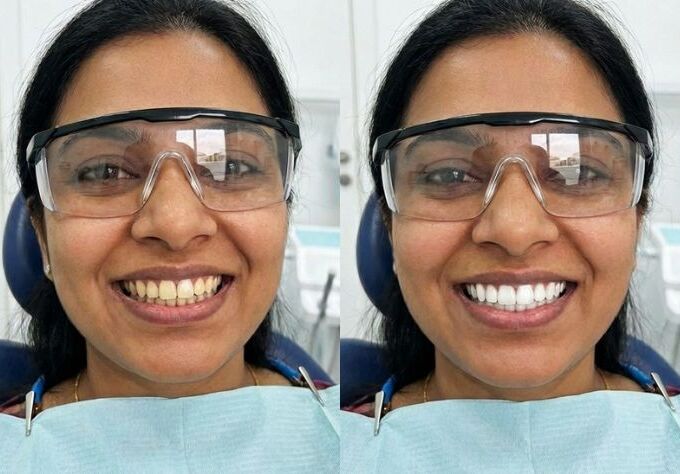 Laser teeth whitening before and after comparison showing removal of stains and visibly whiter teeth after treatment.
