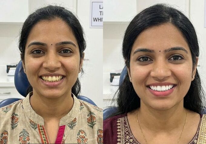 Laser teeth whitening before and after results showing a brighter and whiter smile after professional cosmetic dental treatment.