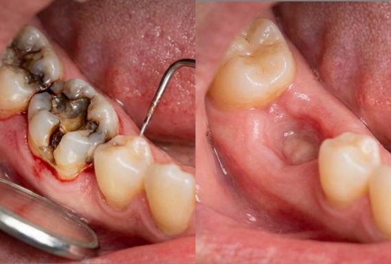 Before and after molar tooth extraction showing damaged tooth removal and healthy gum healing related to tooth extraction cost in Kolkata.