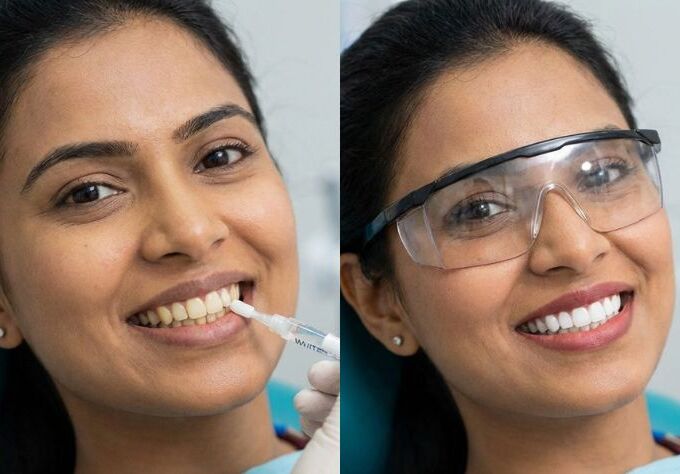 Patient receiving professional laser teeth whitening treatment for brighter and stain-free teeth at a dental clinic.