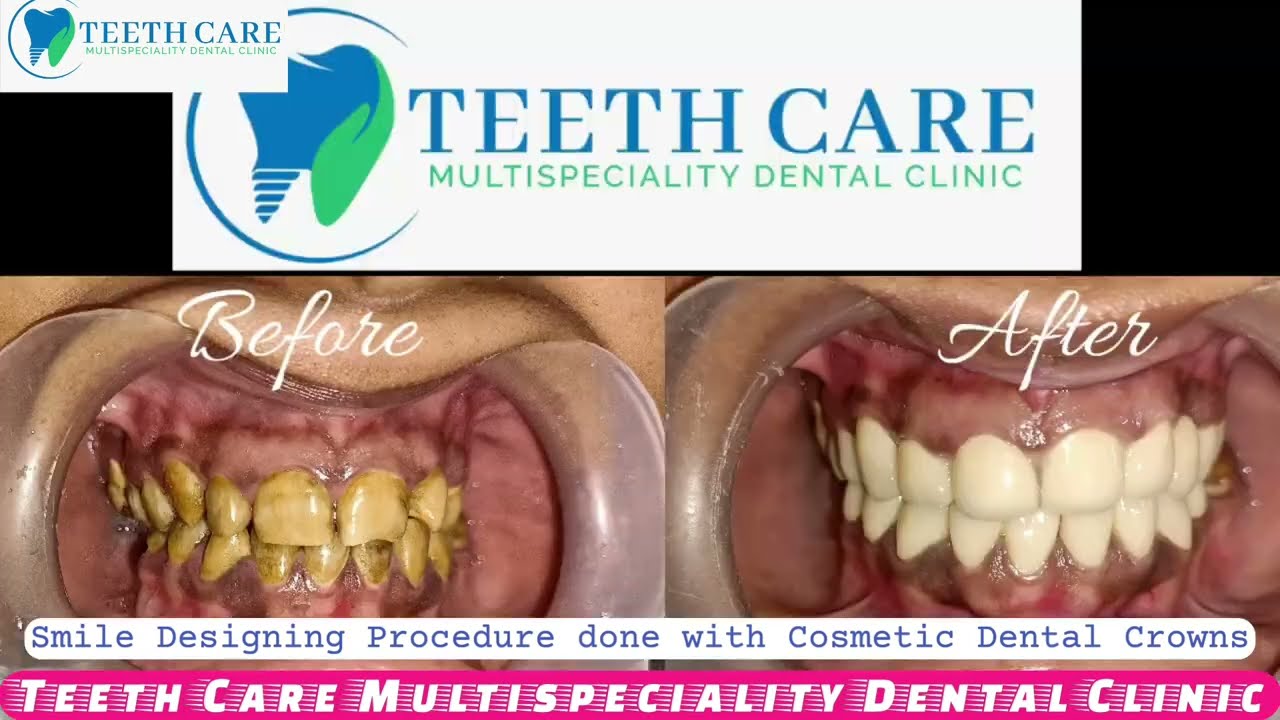 teeth whitening in kolkata