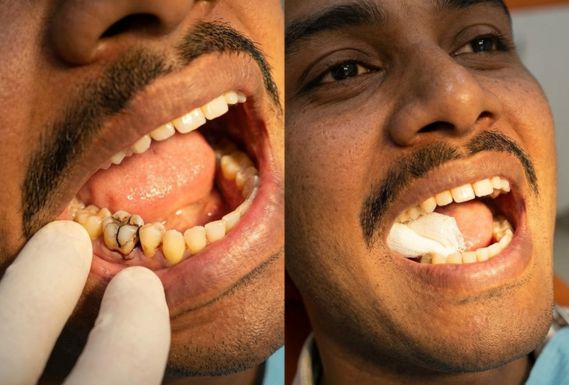Tooth extraction before and after results showing decayed tooth removal by dentist related to tooth extraction cost in Kolkata.